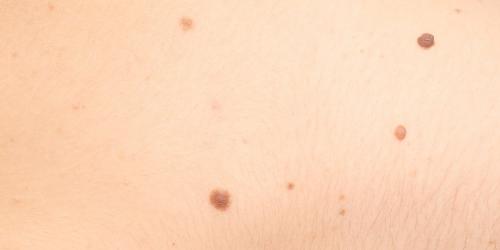 Skin cancer: the signs that need to alert